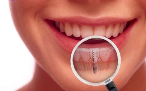 melbourne-dental-implant